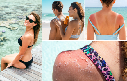 How Does A Sunburn Develop and What to Do When You Get a Sunburn?